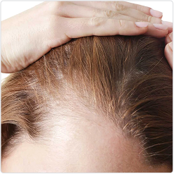 Person parting their hair to reveal thinning at the scalp, indicating hair loss.