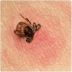 Close-up of a tick attached to reddened human skin, showing early signs of Lyme disease.
