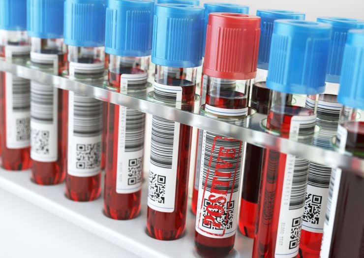 Blood sample vials with barcode labels in a laboratory rack, one marked positive for autoimmune disease testing